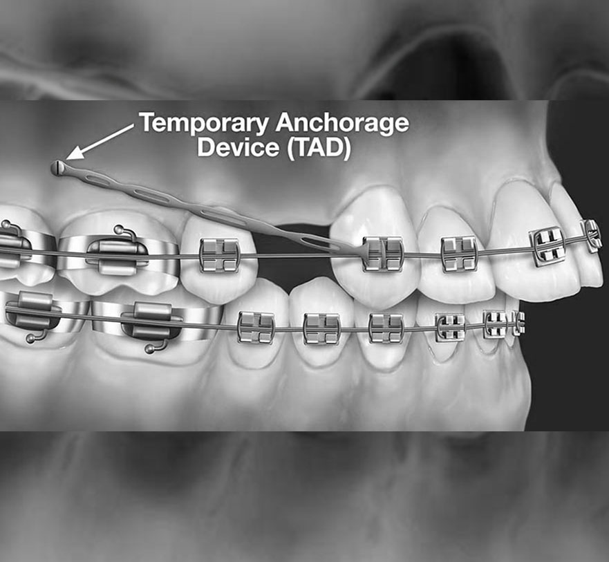 Temporary anchorage devices